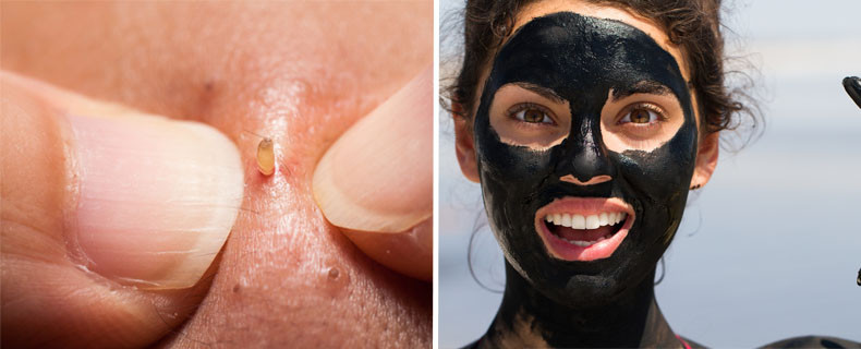 Anti Mitesser Maske Diy
 WTF Diese schwarze DIY Maske zieht alle Mitesser raus