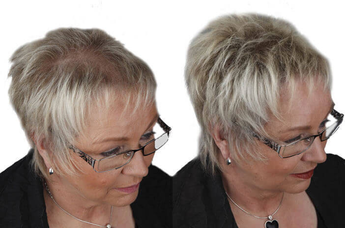 Frisuren Für Lichtes Haar Am Oberkopf
 Schütthaar gegen Haarausfall dünnes Haar und kahle