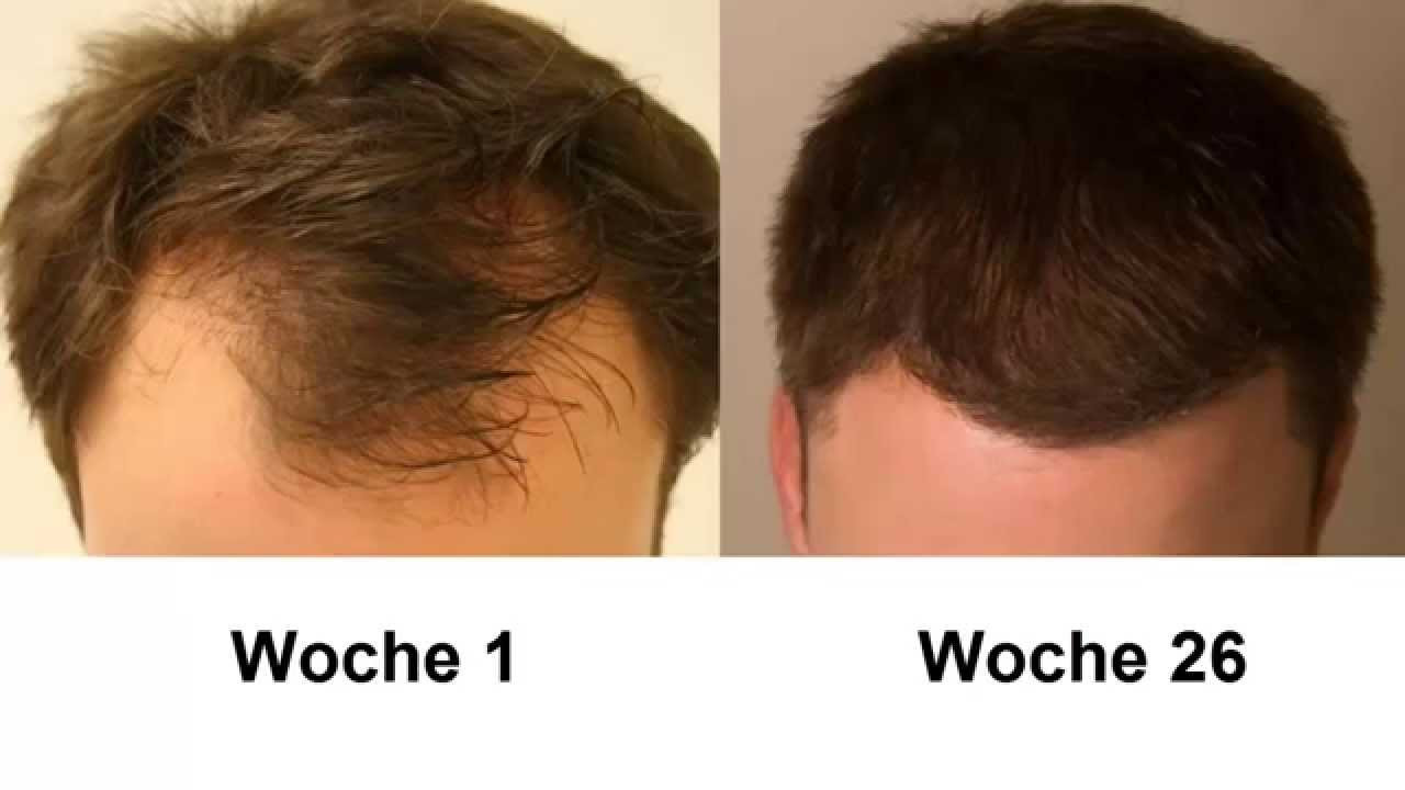 Haarausfall Frisuren
 Was tun gegen Haarausfall oder Geheimratsecken Meine