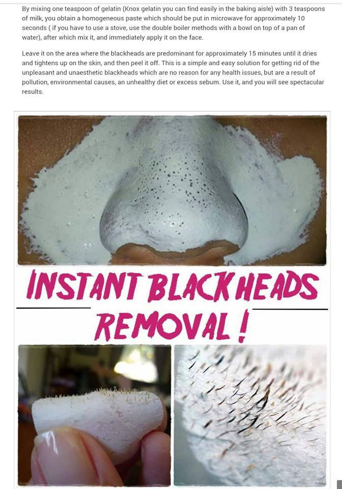 Diy Blackhead Mask
 17 Best ideas about Blackhead Remover on Pinterest