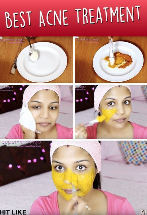 Diy Gesichtsmaske Gegen Pickel
 Do It Yourself Gesichtsmaske gegen Akne