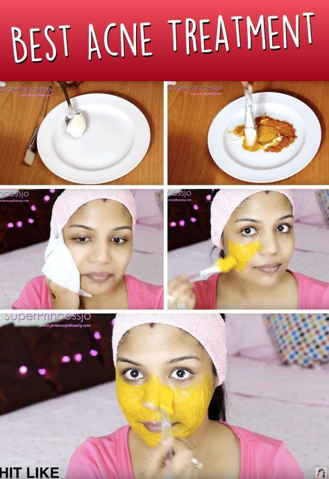 Diy Maske Gegen Pickel
 Do It Yourself Gesichtsmaske gegen Akne