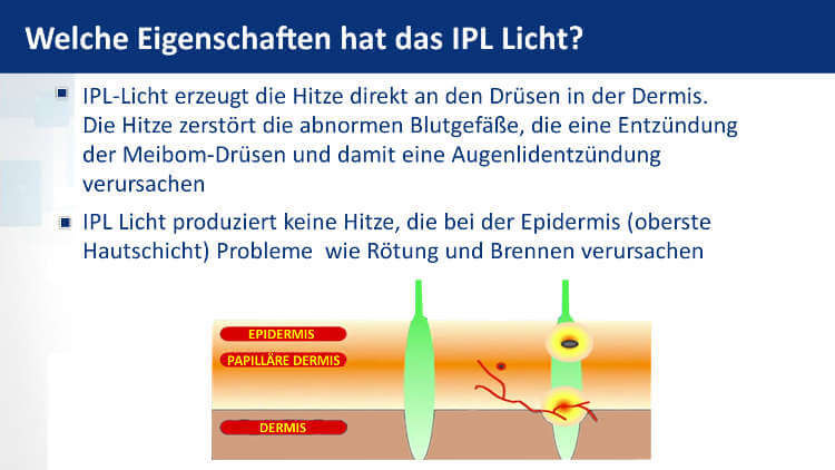 Eigenschaften Von Licht
 Trockene Augen und Blepharitis behandeln mit IPL