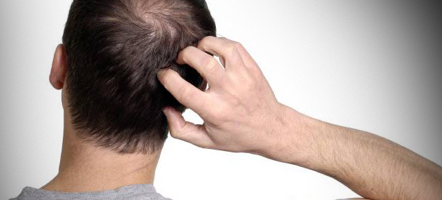 Frisuren Bei Haarausfall Frau
 Haarausfall Ursachen und Abhilfe bei Haarausfall