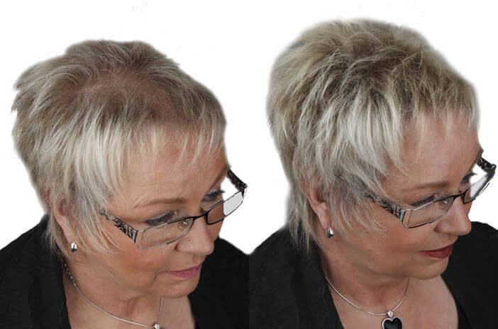 Frisuren Bei Haarausfall Frau
 Schütthaar gegen Haarausfall dünnes Haar und kahle