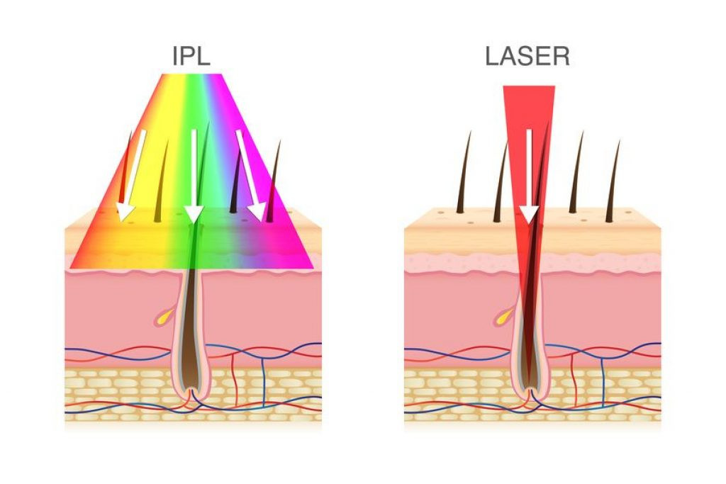 Haarentfernung Mit Licht
 Haarentfernung mit Licht – Funktionsweise Voraussetzungen