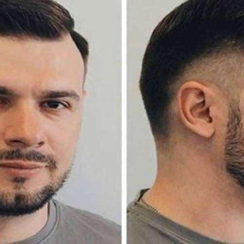 Frisuren Bei Haarausfall
 Frisuren Männer Für Haarausfall