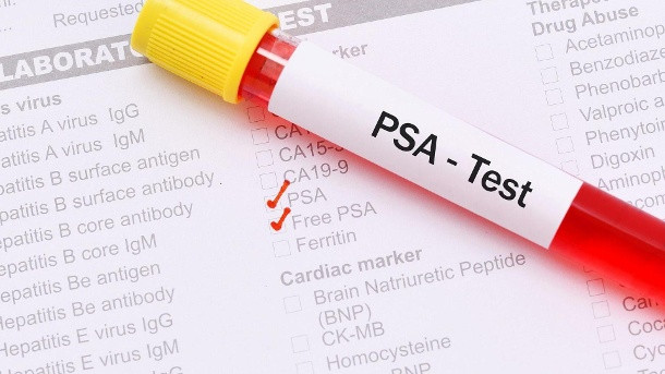 Psa Wert Tabelle
 PSA Wert Was er über Prostatakrebs aussagt und wie Sie