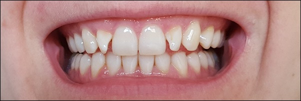 Zähne Bleichen Zu Hause
 Zahnaufhellung zu Hause Zähne bleichen mit Strips für 14